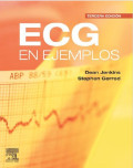 ECG en ejemplos